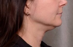 before thermirf neck area female patient side view case 3