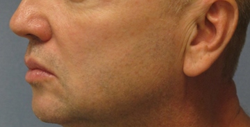 after thermirf neck area male patient side view case 2