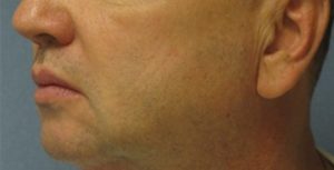 before thermirf neck area male patient side view case 3