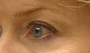 after thermirf eye area female patient side view case 1