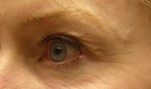 before thermirf eye area female patient side view case 1