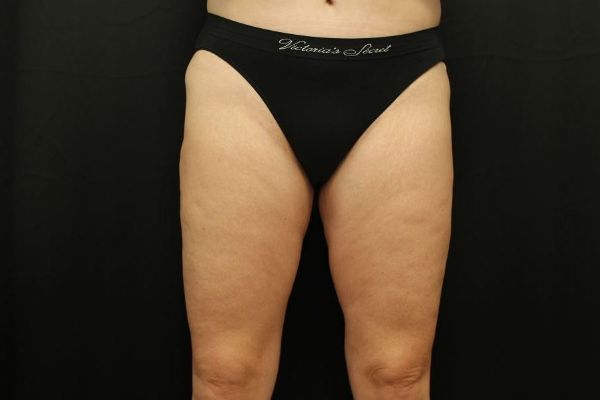 after thigh lift front view female patient case 1
