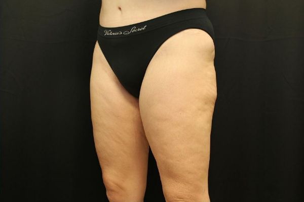 after thigh lift left angle view female patient case 1