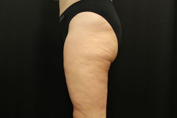 after thigh lift left view female patient case 1