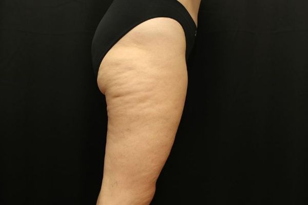 after thigh lift right view female patient case 1