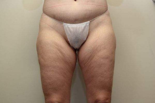 before thigh lift front view female patient case 1