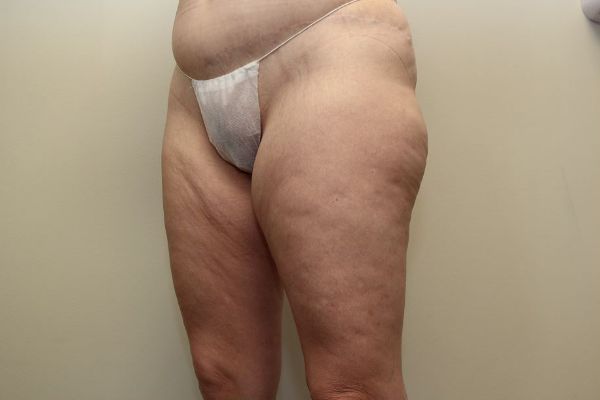 before thigh lift left angle view female patient case 1