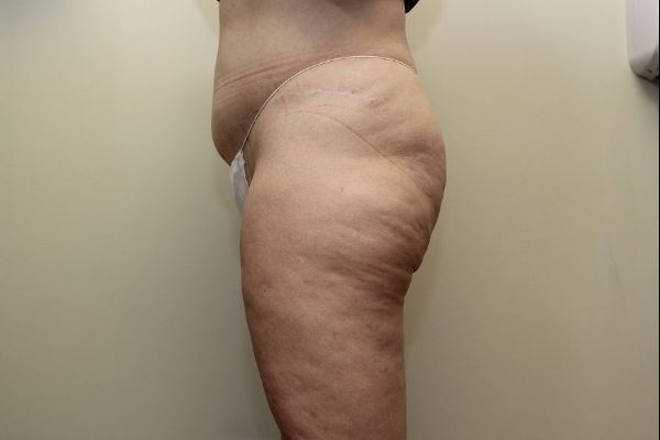 before thigh lift left view female patient case 1