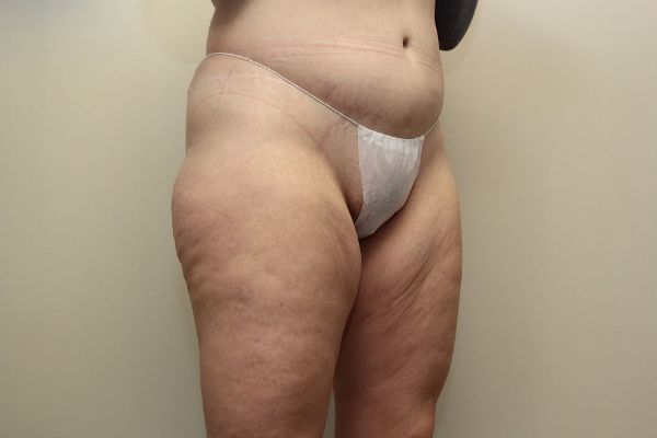 before thigh lift right angle view female patient case 1