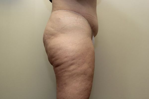 before thigh lift right view female patient case 1