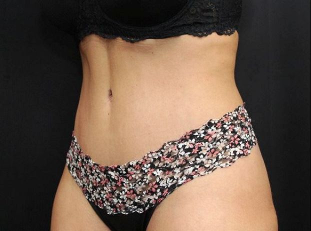 after tummy tuck left angle view female patient case 17