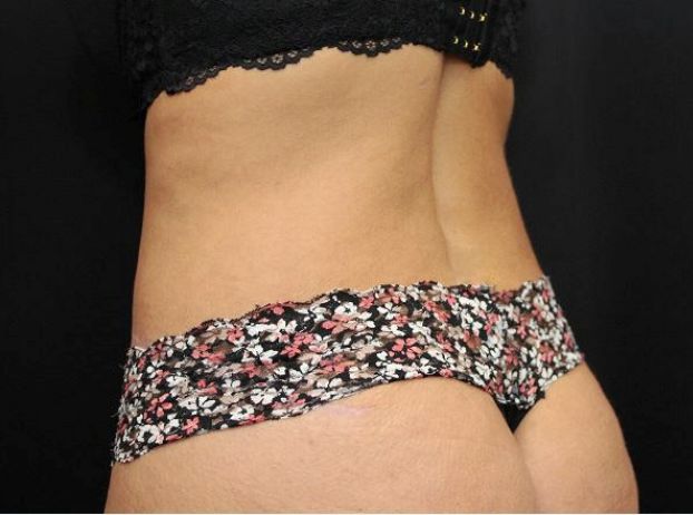after tummy tuck back left view female patient case 17