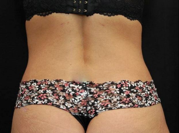 after tummy tuck back view female patient case 17