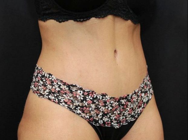 after tummy tuck right angle view female patient case 17