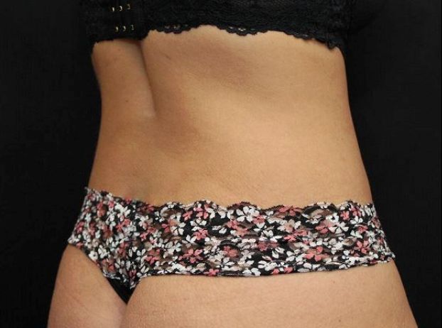 after tummy tuck back right view female patient case 17