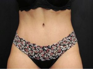 after tummy tuck front view female patient case 17