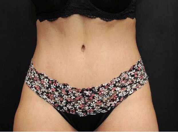 after tummy tuck front view female patient case 17