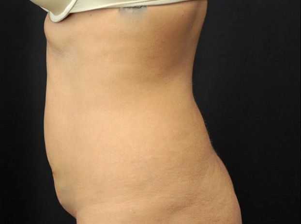 before tummy tuck left view female patient case 17