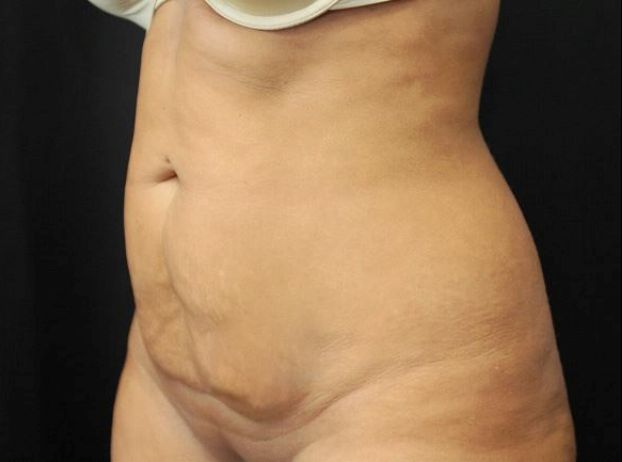 before tummy tuck left angle view female patient case 17