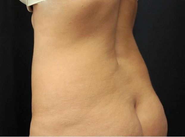 before tummy tuck back left view female patient case 17
