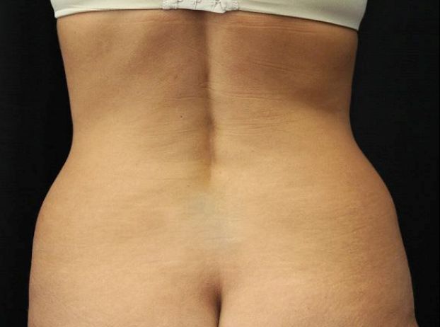 before tummy tuck back view female patient case 17
