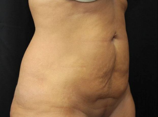 before tummy tuck right angle view female patient case 17