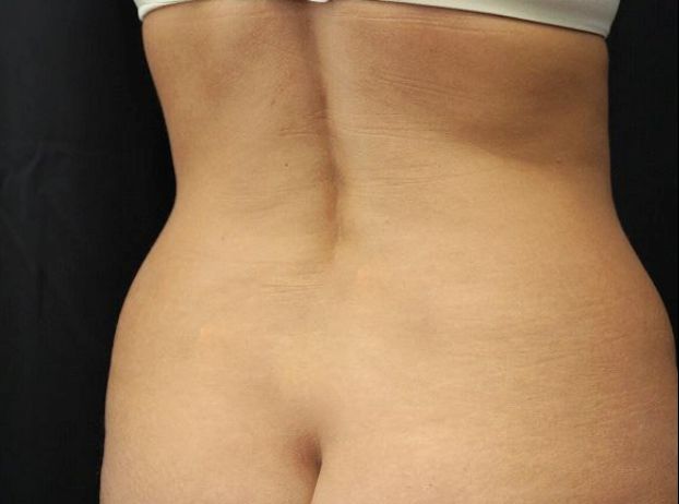 before tummy tuck back right view female patient case 17