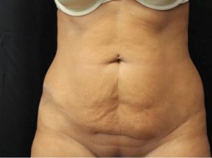 before tummy tuck front view female patient case 17