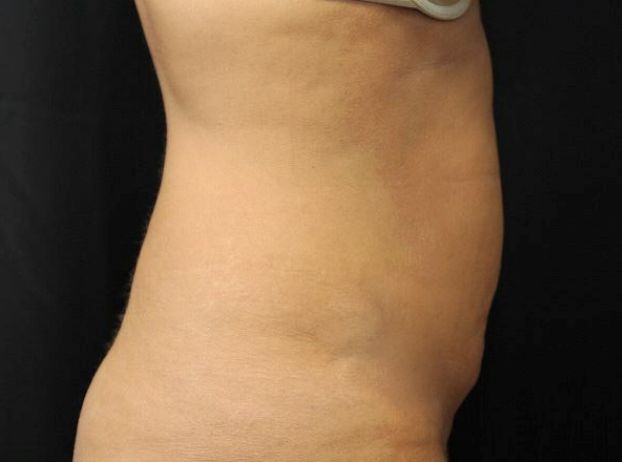 before tummy tuck right view female patient case 17