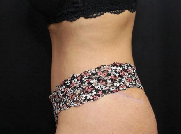 after tummy tuck left view female patient case 17