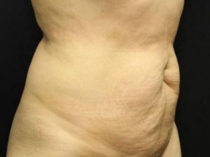 before tummy tuck right angle view female patient case 19
