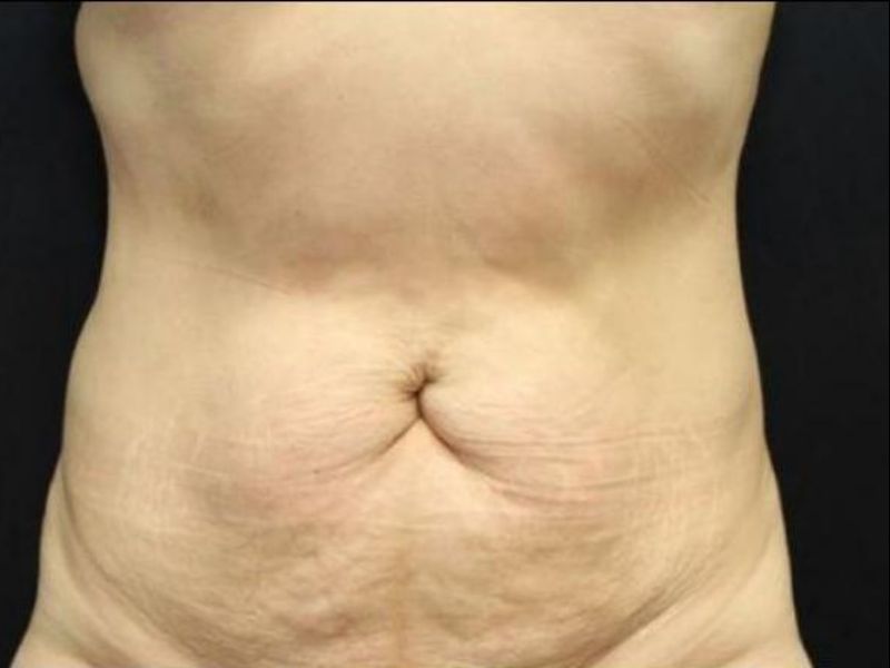 before tummy tuck front view female patient case 19