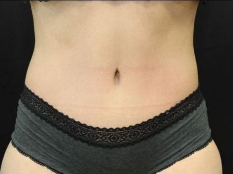 after tummy tuck front view female patient case 19