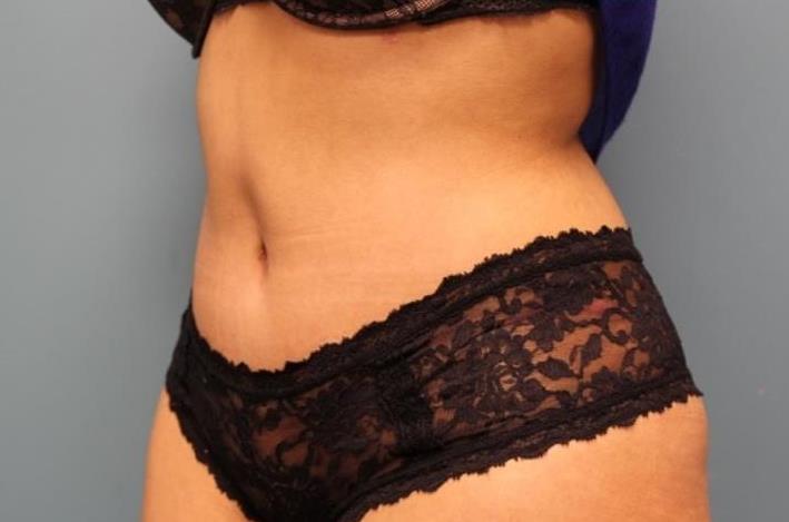 after tummy tuck left angle view female patient case 38