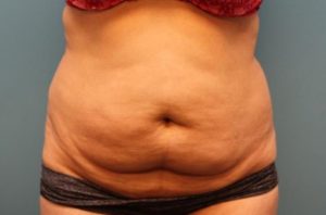 before tummy tuck front view female patient case 38