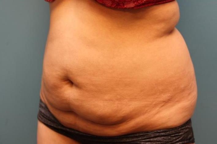before tummy tuck left angle view female patient case 38