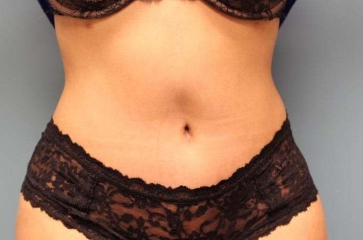 after tummy tuck front view female patient case 38