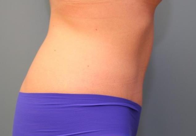 after tummy tuck right view female patient case 37