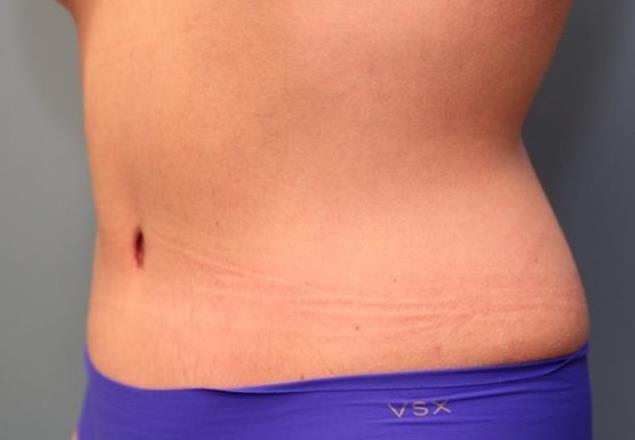after tummy tuck left angle view female patient case 37