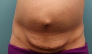 before tummy tuck front view female patient case 37