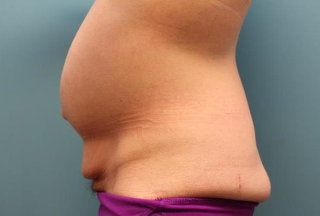 before tummy tuck left view female patient case 37