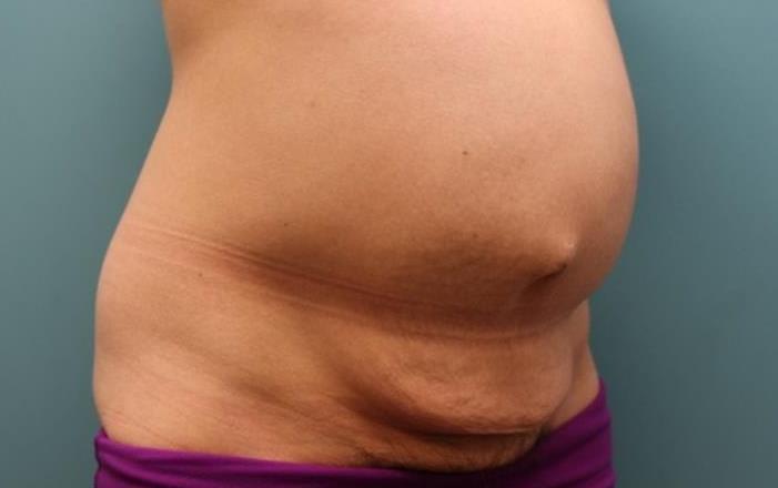 before tummy tuck right angle view female patient case 37
