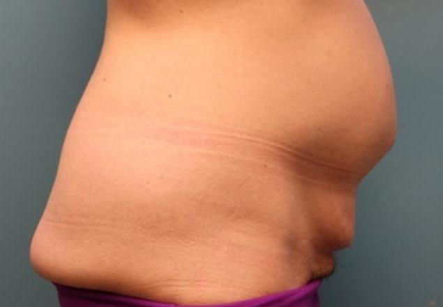 before tummy tuck right view female patient case 37