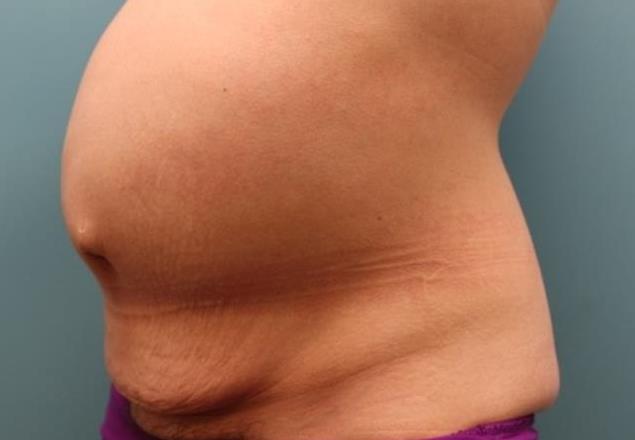 before tummy tuck left angle view female patient case 37