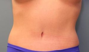 after tummy tuck front view female patient case 37