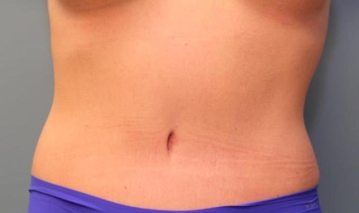 after tummy tuck front view female patient case 37