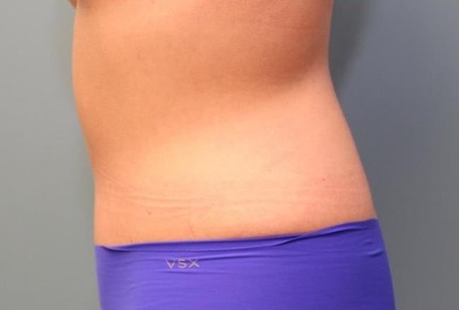 after tummy tuck left view female patient case 37