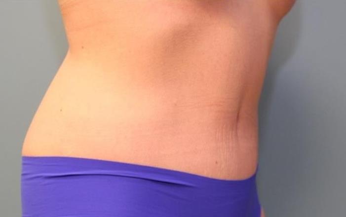 after tummy tuck right angle view female patient case 37
