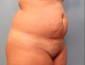 before tummy tuck right angle view female patient case 35