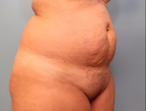 before tummy tuck right angle view female patient case 35
